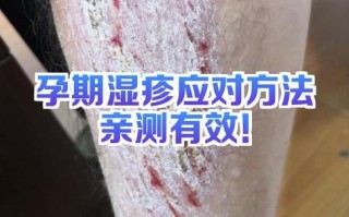 孕期为何更易患乳晕湿疹？症状、诱因及应对策略全解析