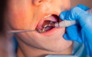 儿童全麻拔牙安全吗？风险与家长最该关注的注意事项有哪些？