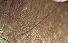 孕期下体长小疙瘩奇痒是何原因？对胎儿有影响吗？该怎么处理？