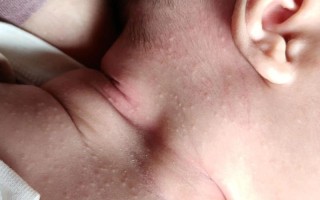 新生儿脖子闪了有哪些具体表现？家长该如何判断和处理？