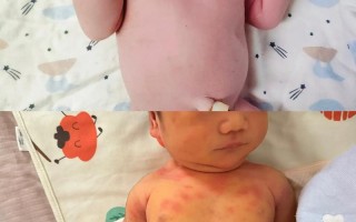 儿童猩红热早期症状有哪些？家长如何快速识别与应对？