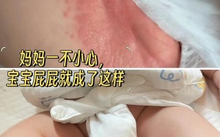 新生儿屁股红是因为拉屎次数多还是护理方式不对？