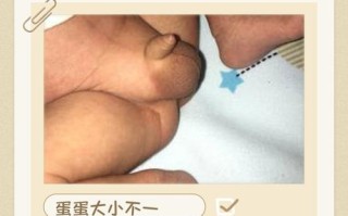 新生儿的小鸡短怎么办