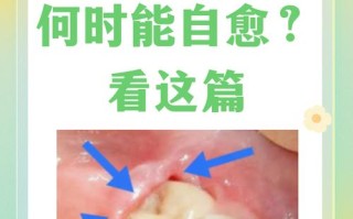 备孕智齿发炎怎么办？