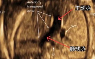 孕期胎儿心脏超声解剖，如何精准识别复杂结构异常？