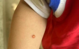 新生儿身上长个肉赘.