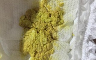 新生儿黄疸吃药后大便颜色变深是正常现象吗？需要调整用药吗？