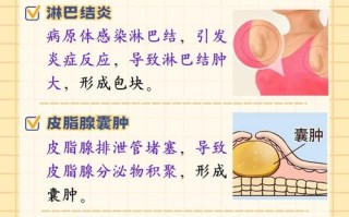 孕期腋下淋巴结肿大要紧吗？