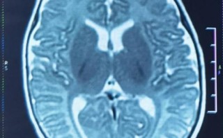 新生儿核磁共振究竟会检查身体哪些部位，能发现哪些潜在问题呢？