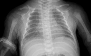 新生儿拍X光片到底会不会对身体造成潜在影响？