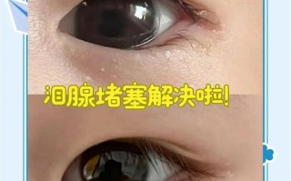 新生儿鼻泪管不通有哪些典型症状？家长该如何判断和处理？