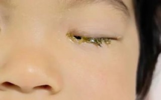 新生儿九天眼睛有眼屎
