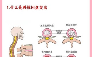 怀孕期间腰椎间盘突出，该如何缓解疼痛并保障母婴健康？