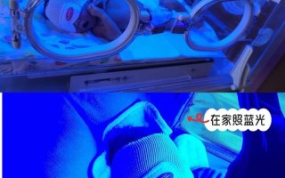 新生儿溶血性黄疸照蓝光，原理是什么？家长需要知道哪些注意事项？