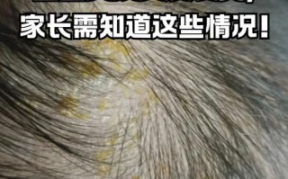 新生儿头发稀黄是缺营养吗？