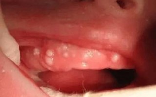 新生儿下面白色粘稠物是什么？需要清理吗？会影响健康吗？