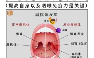 儿童扁桃体炎治疗方法