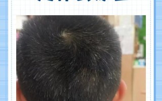 新生儿前面头发稀少是缺营养还是正常现象？