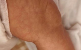 新生儿金色葡萄菌感染