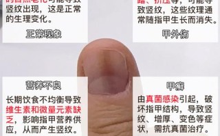 儿童指甲竖纹是缺营养还是生病了？
