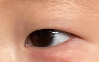 新生儿眼睛下面有红点是正常现象吗？需要担心吗？