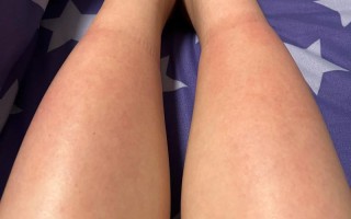 孕期28周出现水肿是正常的生理现象吗？需要担心吗？