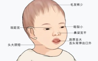 新生儿先天性甲状腺功能低下症如何早发现早干预？