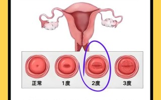 孕期宫颈糜烂影响胎儿吗？安全治疗方法有哪些？
