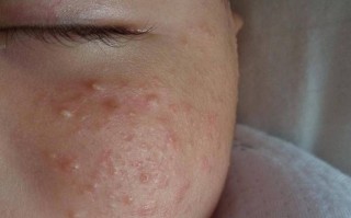 新生儿脸上长白色脓疱是何原因？该如何正确处理与护理？