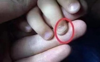 儿童指甲凹陷是缺营养还是疾病信号？需要警惕哪些健康问题？