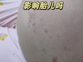 孕期湿疹会影响胎儿健康吗？会对胎儿发育造成哪些潜在风险？