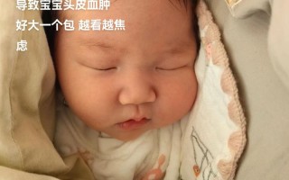 新生儿头皮血肿多久能自然吸收？