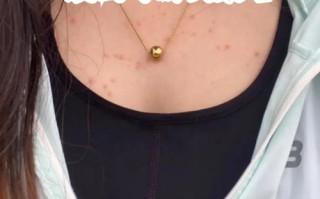 孕期胸前长痘痘是激素变化还是皮肤问题？