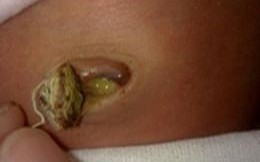 新生儿肚脐出现黄色分泌物是正常现象还是感染信号？需如何处理？