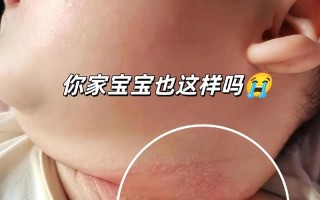 新生儿脖子红红的怎么办？是湿疹还是摩擦引起的？该怎么护理才好？