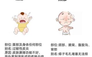 儿童过敏性湿疹怎么治？