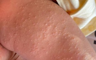 新生儿皮肤突然长红疙瘩，是湿疹、热疹还是过敏信号？
