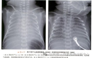新生儿肺透明膜病有哪些典型临床表现？