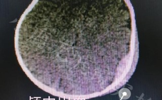 新生儿颅内出血陈旧性，为何难以早期发现？如何干预预后？