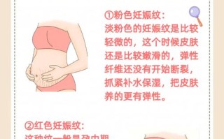 孕期肚子上长妊娠纹怎么办？