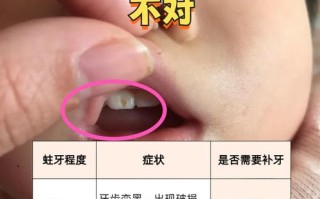 儿童乳牙有蛀洞，到底该不该治？
