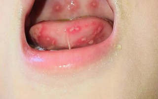 儿童咽峡炎的症状图片