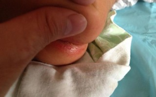 新生儿肛门褶皱处破皮是什么原因导致的？需要如何正确护理和预防感染？