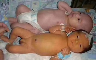 新生儿蚕豆病黄疸有哪些症状？如何区分与普通黄疸？