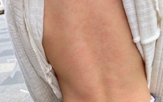 儿童荨麻疹图片和症状有哪些？不同年龄段症状差异大吗？