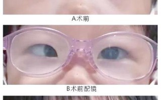 新生儿斗鸡眼是正常现象还是需要矫正？家长该如何科学应对？