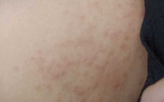 孕期甘胆酸偏高会有哪些明显症状？对胎儿健康有什么影响？