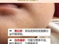 新生儿脸上有小白点是何原因？