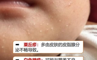 新生儿脸上有小白点是何原因？