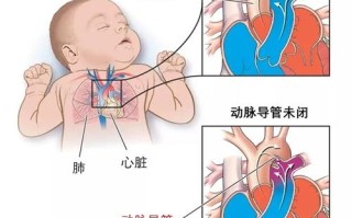 新生儿动脉导管未闭症状有哪些？